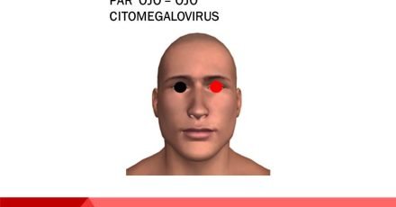 Par Ojo - Ojo ( Citomegalovirus )