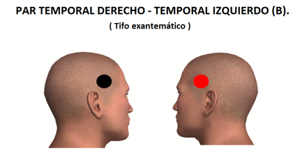 par temporal derecho-temporal izquierdo