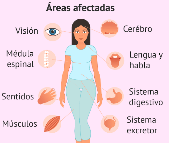 La Esclerosis múltiple La Esclerosis múltiple