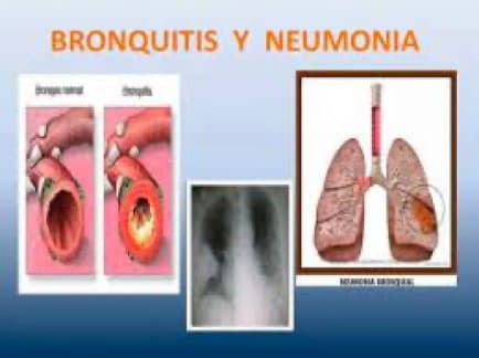 Tratamiento de Bronquitis bacterianas y víricas con Biomagnetismo Tratamiento de Bronquitis bacterianas y víricas con Biomagnetismo