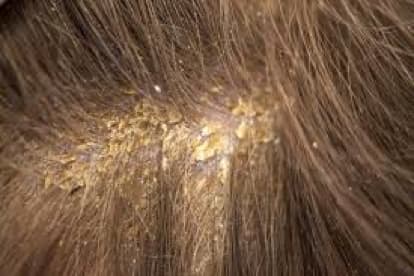 Caspa: Prevención y Tratamiento con Biomagnetismo caspa tratamiento biomagnetismo